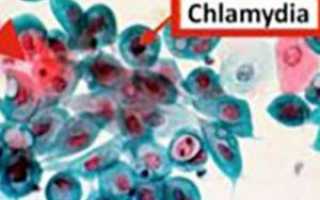 Симптомы хламидиоза и его лечение