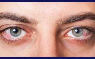 Коронавирус и глаза
