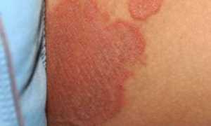 Эритразма — красные пятна на кожи