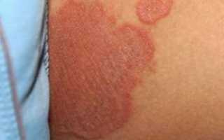 Эритразма — красные пятна на кожи