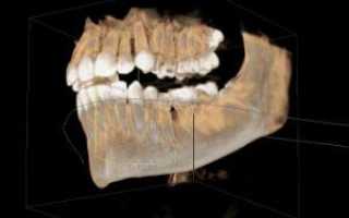 3D-рентген зубов