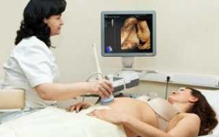 3D УЗИ при беременности
