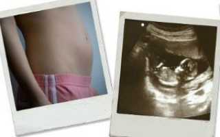 УЗИ на 12 неделе беременности