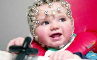 ЭЭГ (энцефалограмма) головного мозга у детей