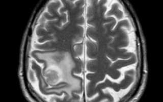 Сколько длится МРТ головного мозга