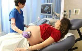 УЗИ на 20 неделе беременности