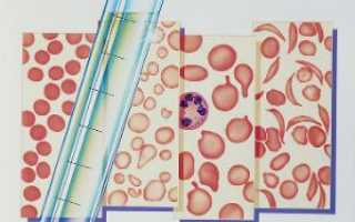 Анализ крови при мононуклеозе