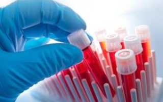 Анализы крови при лейкозе
