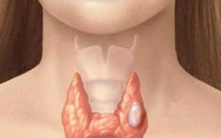 Зоб щитовидной железы и его симптомы