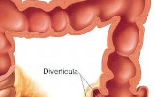 Дивертикулез кишечника и его симптомы
